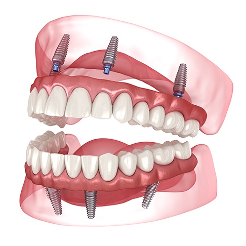 Illustration of All-on-4 dental implants in Brookfield, WI for upper and lower arch