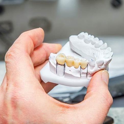 Dental bridge in Brookfield on clay model