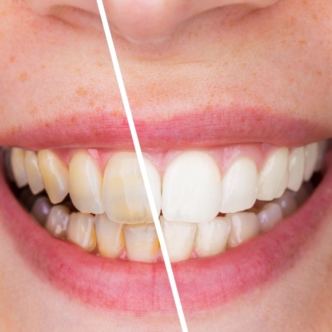 Smile before and after teeth whitening