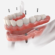 an example of implant dentures in Brookfield