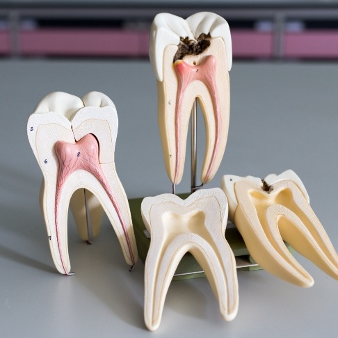 Model healthy tooth compared to model tooth in need of root canal therapy