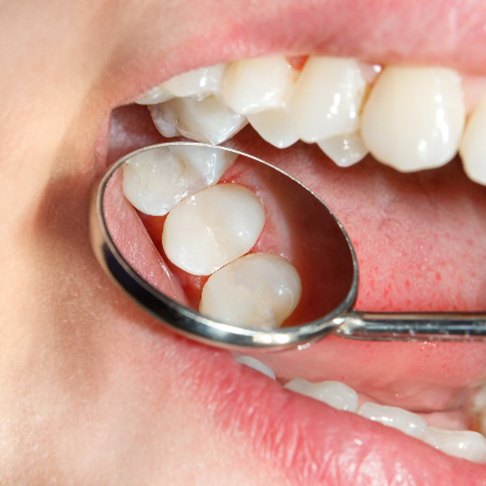 Closeup of smile with tooth colored filling