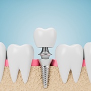 a render of a dental implant being placed