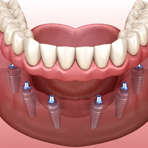 diagram of implant dentures in Brookfield