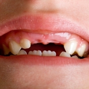 Smile with multiple missing teeth