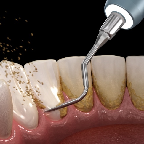 Animated smile during scaling and root planing gum disease treatment