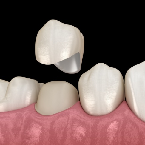 Animated smile during dental crown placement