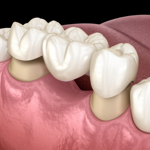 Animated smile during dental bridge placement