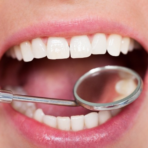 Dentist examining smile after tooth colored filling treatment