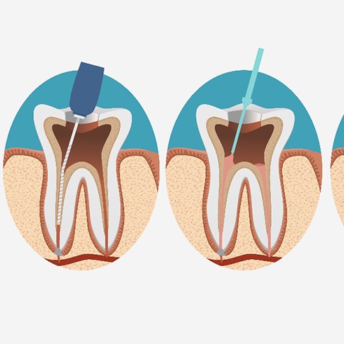 illustration for root canal therapy in Brookfield