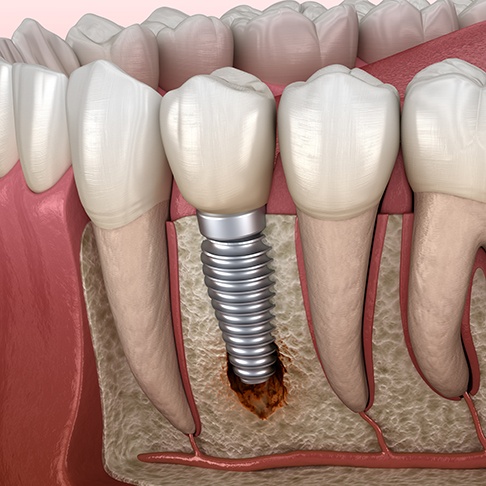 Illustration of bone loss causing dental implant failure in Brookfield, WIBearded man rubbing his jaw