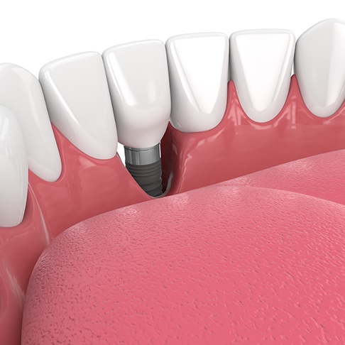 Illustration of failed dental implant viewed from inside of mouth