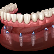 a 3D illustration of implant dentures