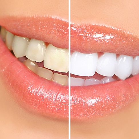 A before-and-after photo highlighting tooth whitening results