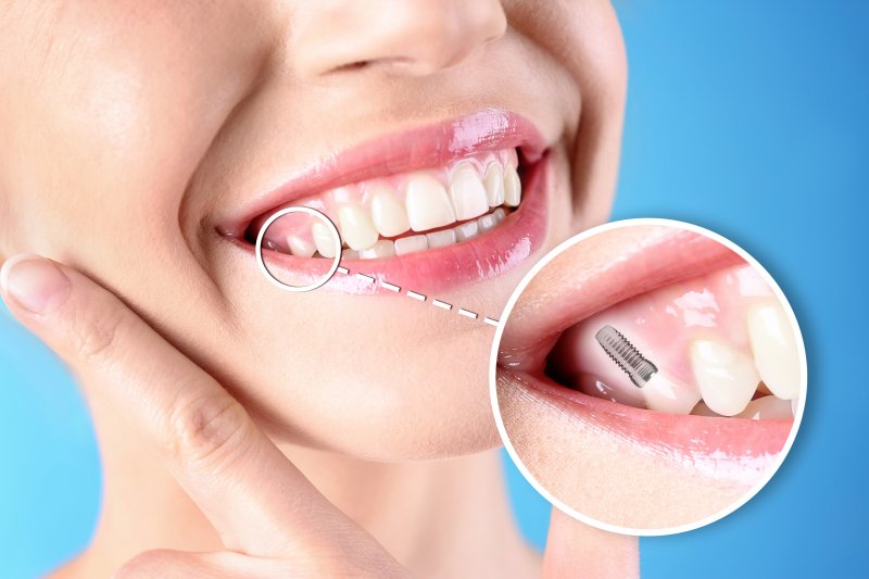 A photo highlighting a woman’s new dental implant