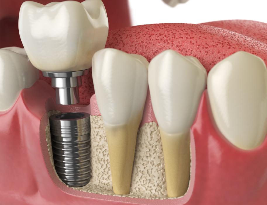 3D illustration of a dental implant